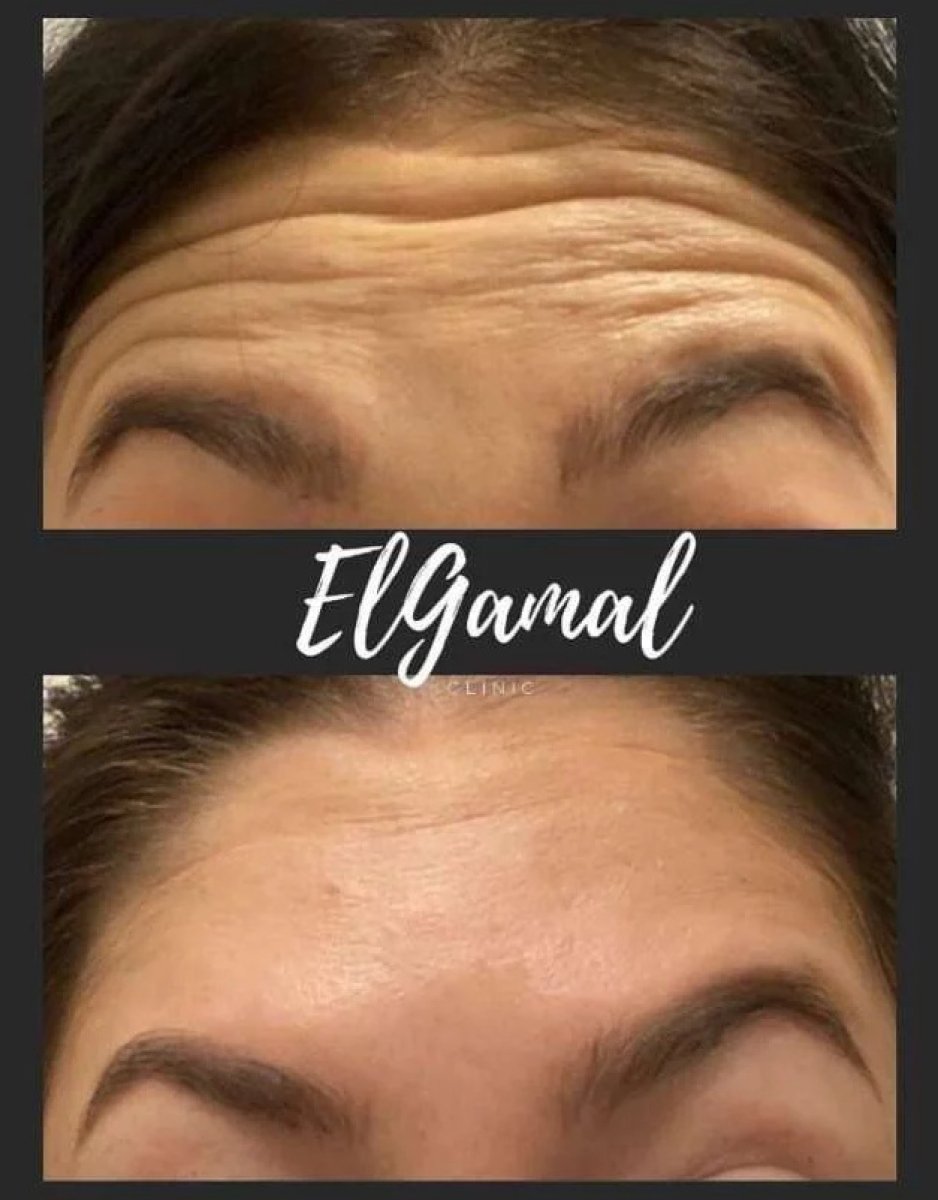 Vorher-nachher-Ergebnis Stirnlifting bei ElGamal Clinic, glattere Stirnhaut