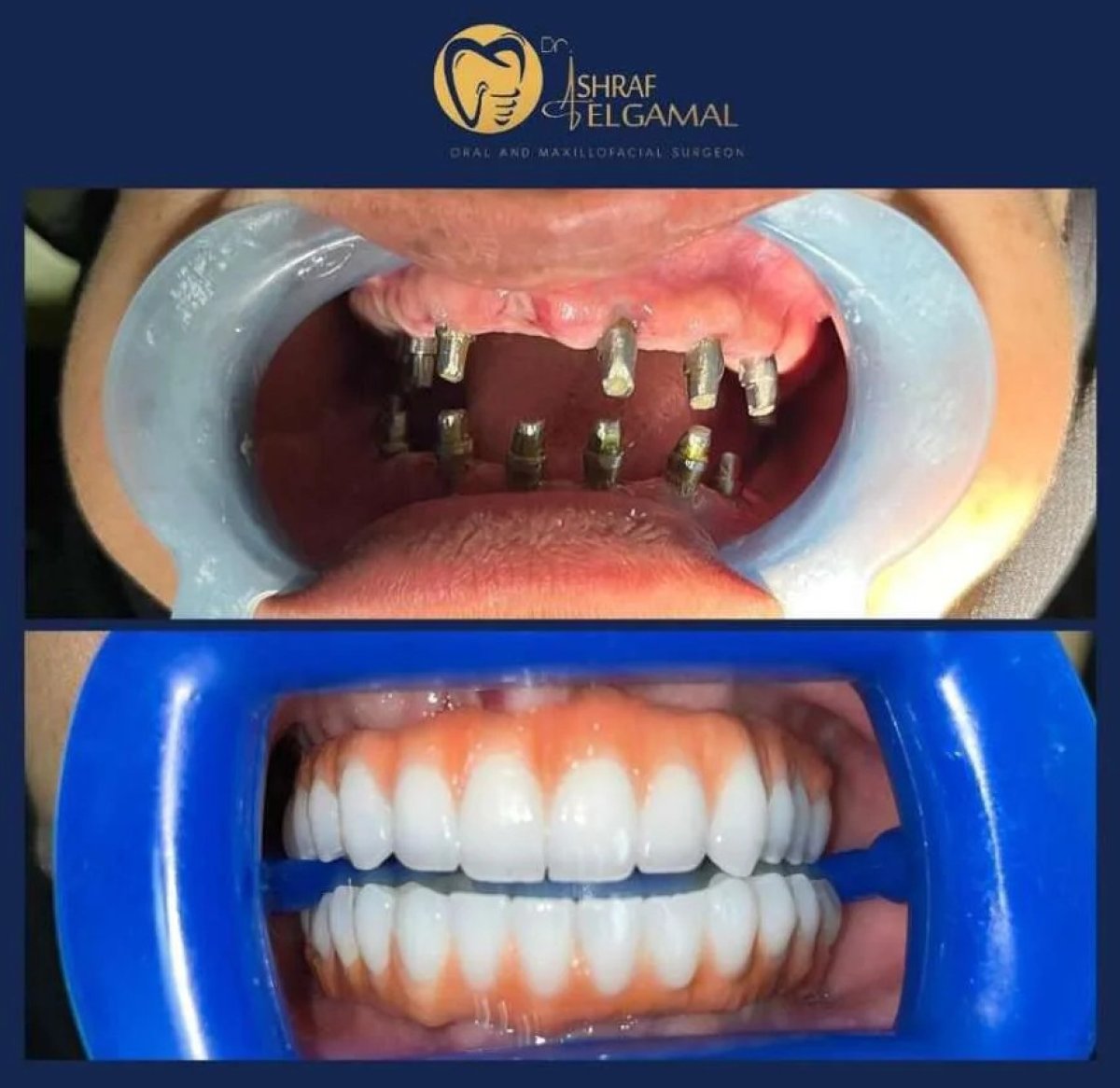Before and after dental implant with crown results at ElGamal Clinic, full smile restoration