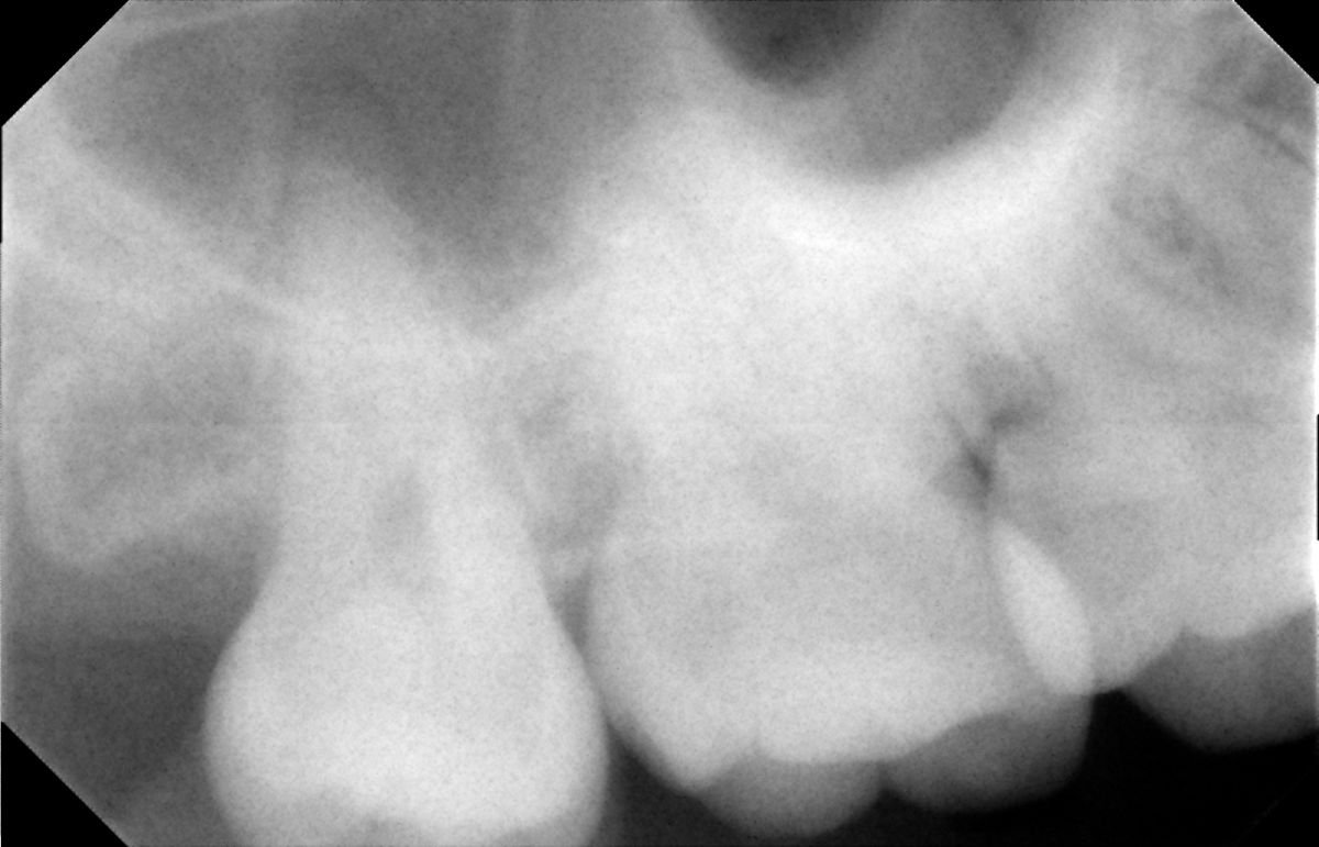 أشعة سينية للأسنان قبل خلع ضرس العقل في SoftDentalCare Clinic، يظهر السن المطمور