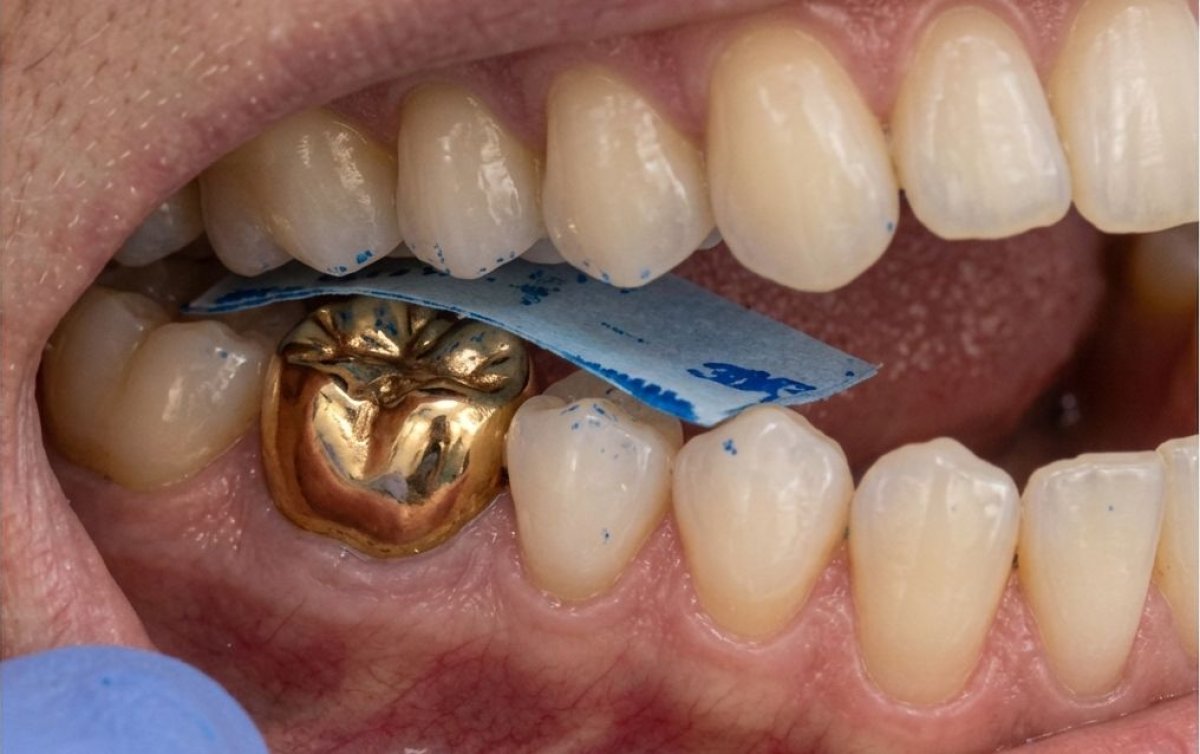 نتيجة تركيب تاج ذهبي للأسنان في SoftDentalCare Clinic مع ضبط دقيق للعضة