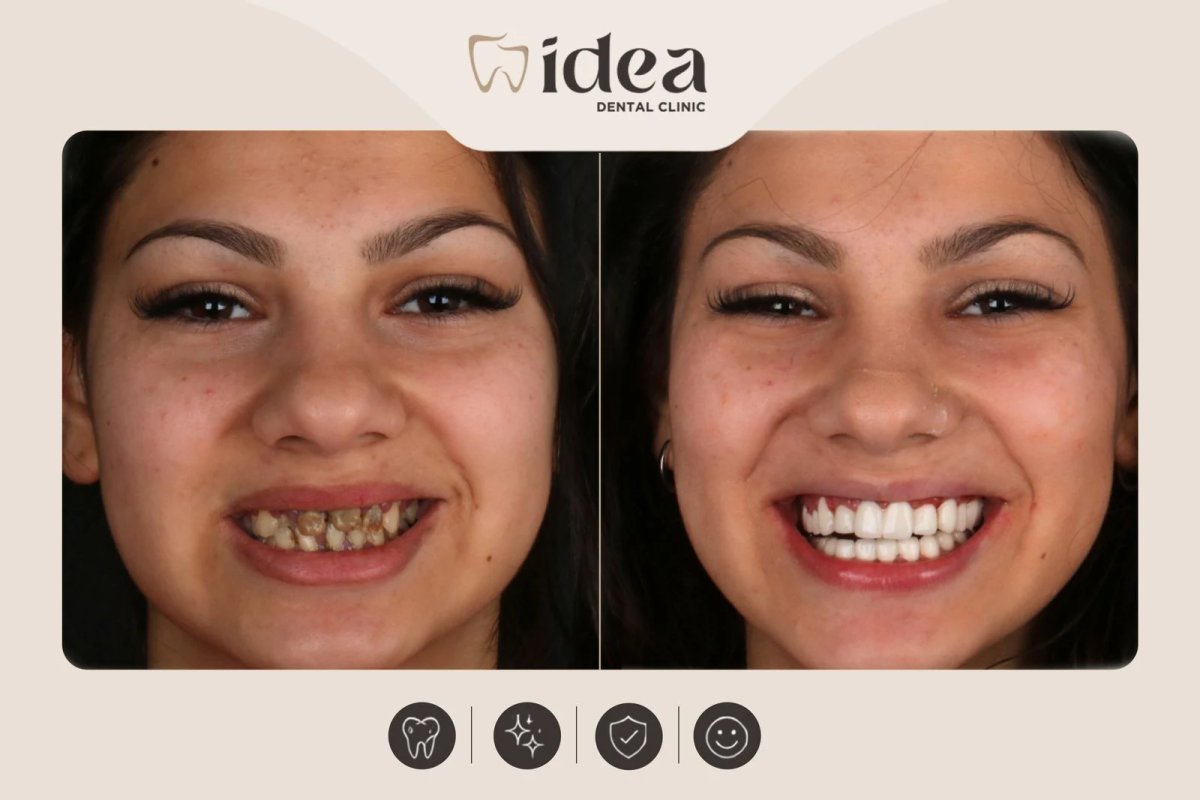 قبل وبعد الفينير في Idea Dental Clinic – تحول الابتسامة بنتائج طبيعية المظهر