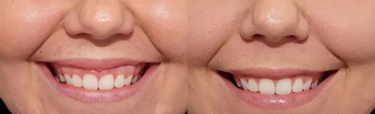 Before and after gingivectomy results at Idea Dental Clinic – improved gum contour and smile