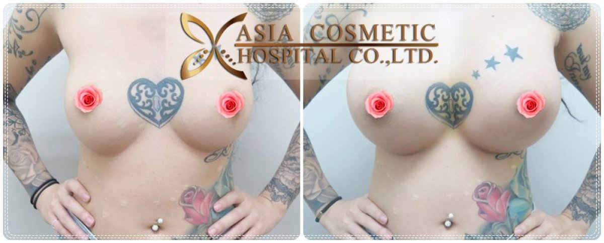 Before and after breast augmentation results at Asia Cosmetic Hospital, enhanced breast volume