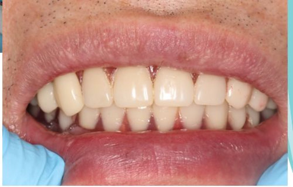 Dental implant result at Xiamen Humanity Hospital – restored smile with natural-looking teeth