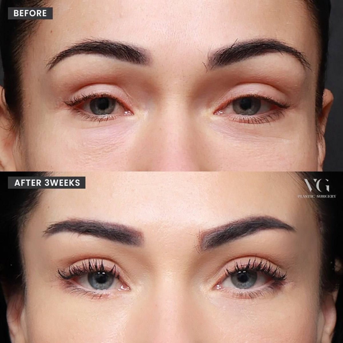 Before and after brow lift results at VG Plastic Surgery, visible eyebrow lift after 3 weeks