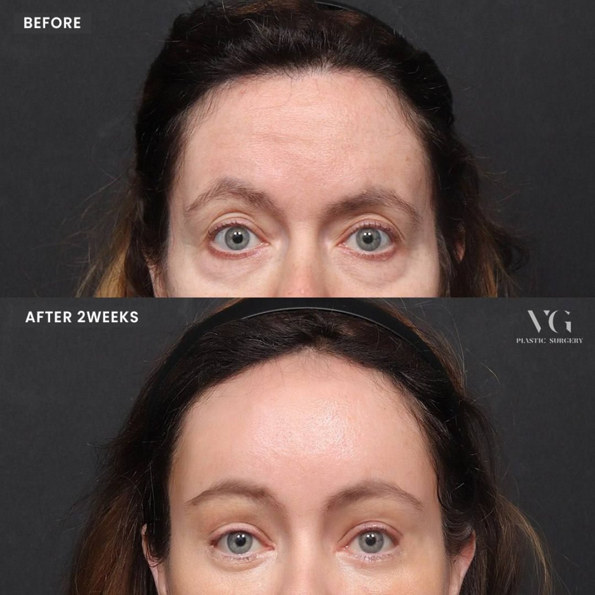 Before and after brow lift results at VG Plastic Surgery – lifted forehead and youthful look