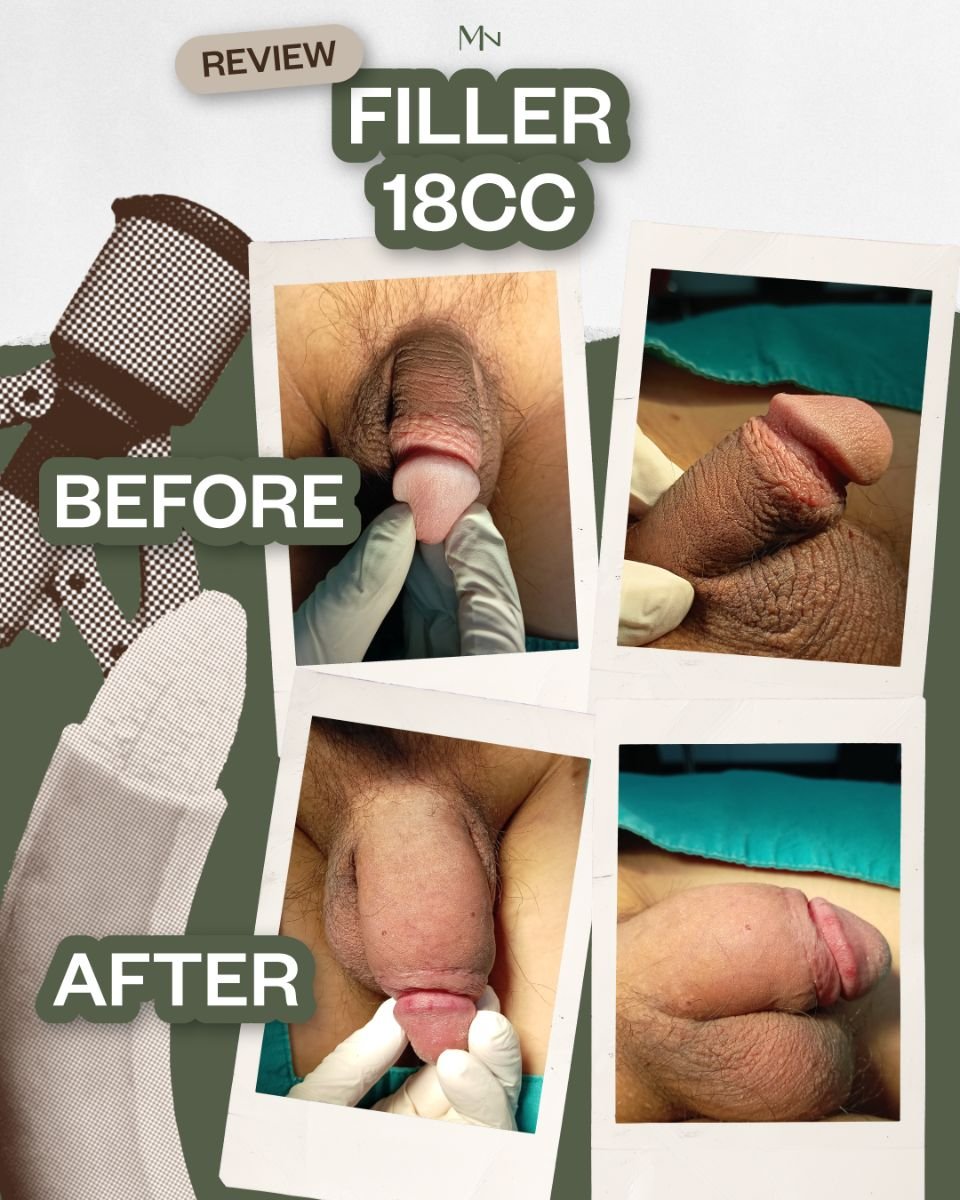 قبل وبعد تكبير القضيب بفيلر 18cc في Menness Wellness Clinic، نتيجة واضحة