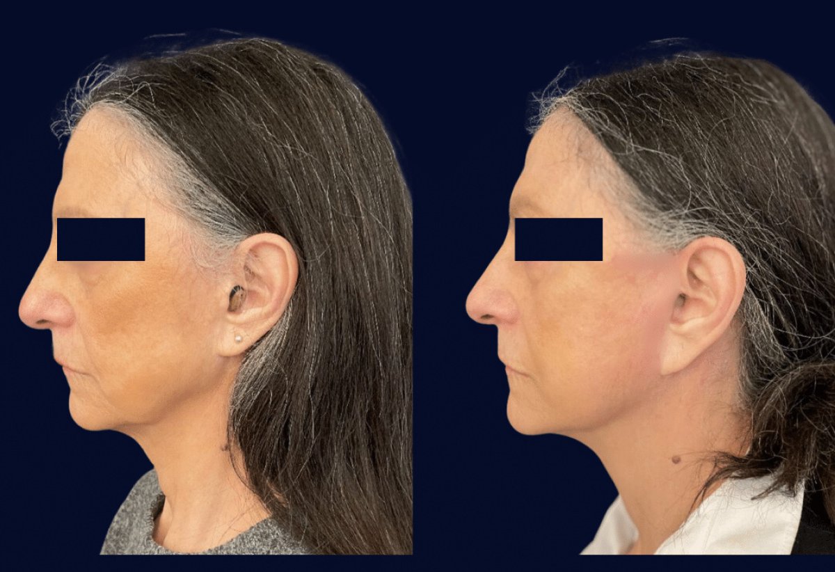 Facelift before and after results at Michaël Benoilid Plastic and Cosmetic Surgeon Paris France