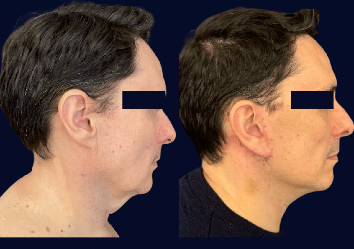 Facelift before and after results at Michaël Benoilid Plastic and Cosmetic Surgeon Paris France