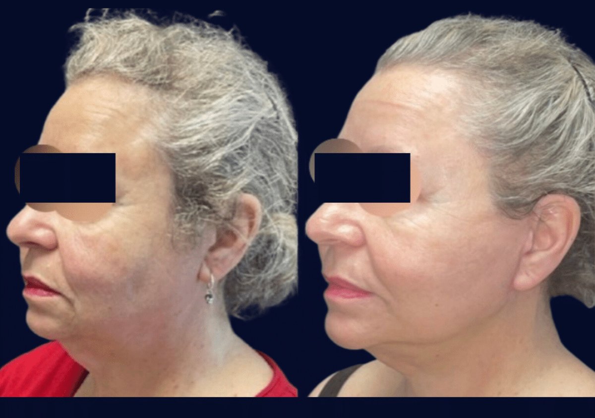 Facelift before and after results at Michaël Benoilid Plastic and Cosmetic Surgeon Paris France