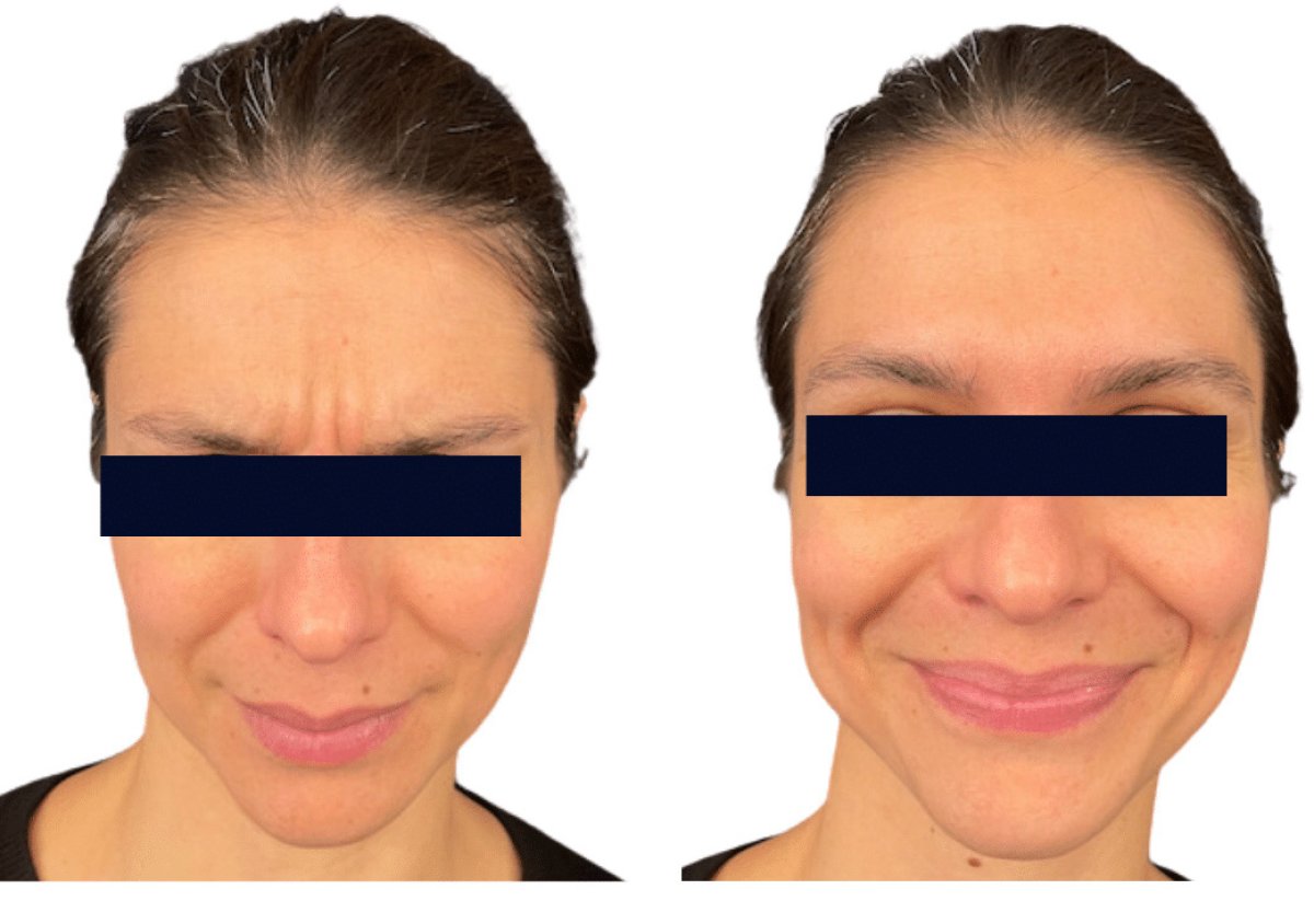 Before and after Botox injections result at Michaël Benoilid Plastic and Cosmetic Surgeon Paris France