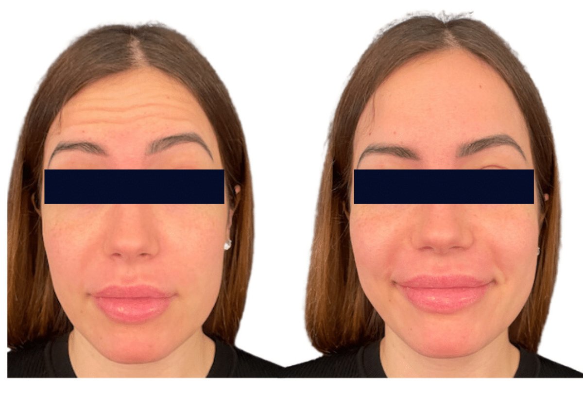 Before and after Botox injections result at Michaël Benoilid Plastic and Cosmetic Surgeon Paris France
