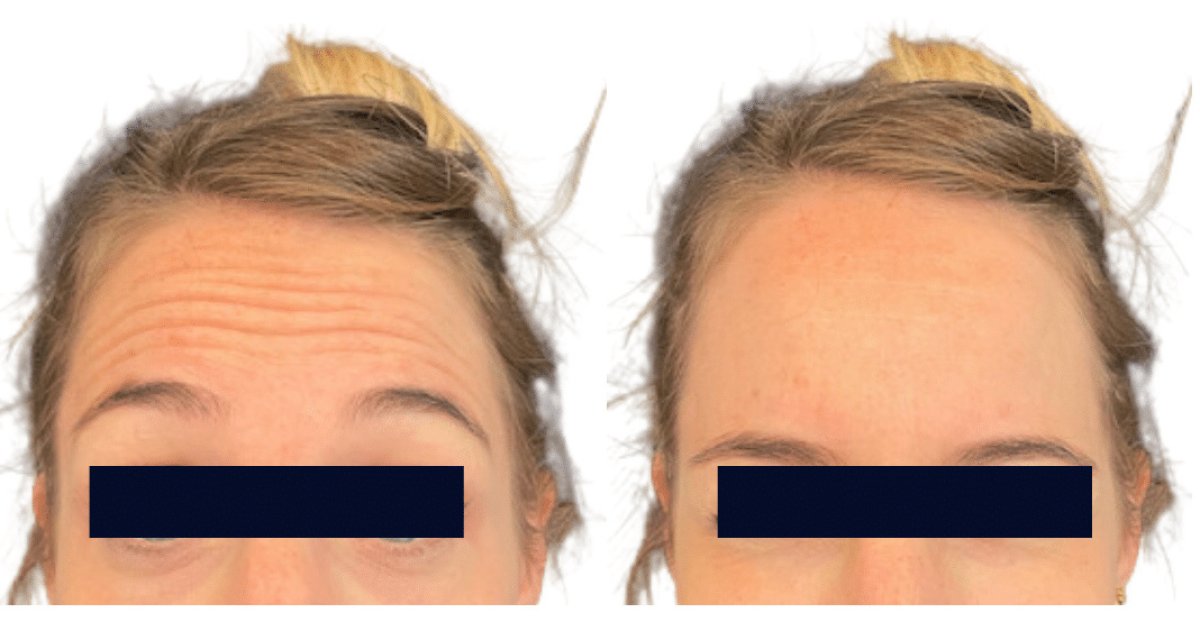 Before and after Botox for forehead wrinkles at Michaël Benoilid Plastic Surgeon Paris France result