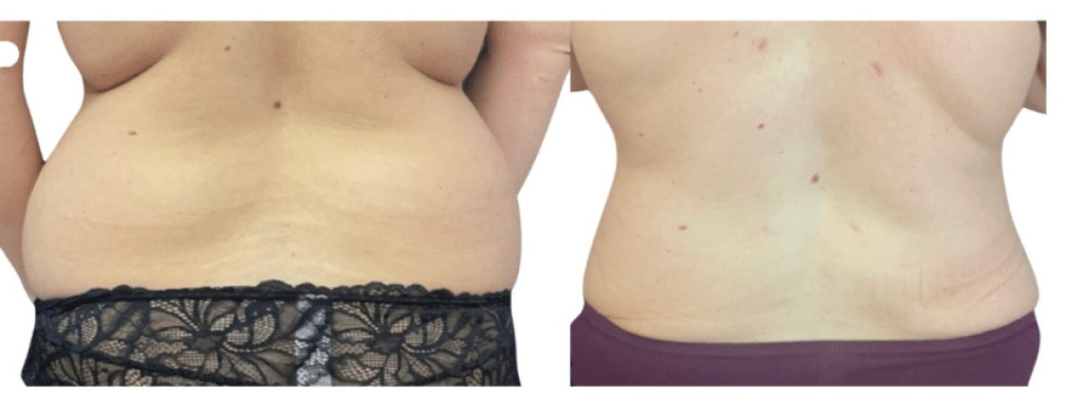 Vorher-nachher-Liposuktionsergebnisse bei Michaël Benoilid Plastic and Cosmetic Surgeon Paris France