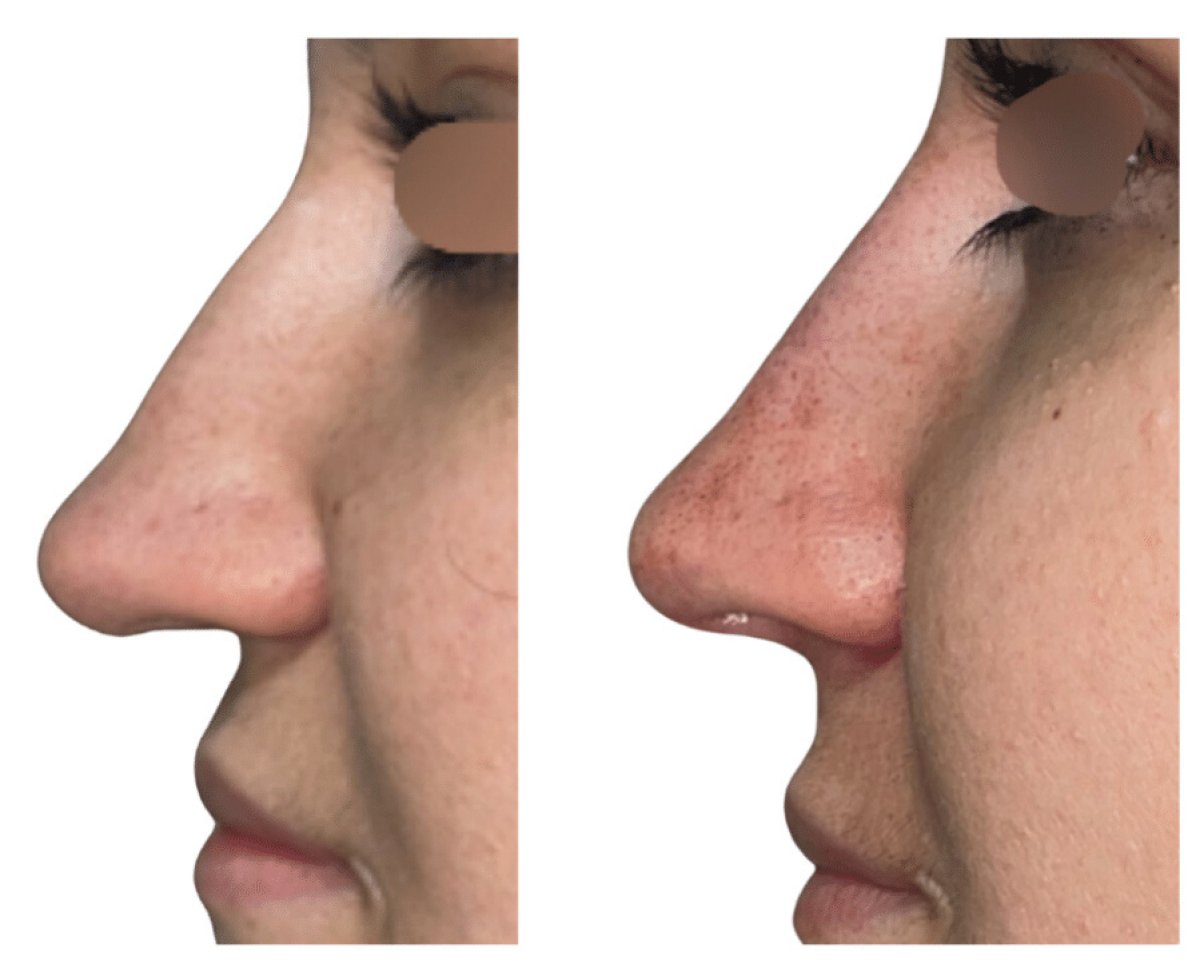 Before and after rhinoplasty results at Michaël Benoilid Plastic and Cosmetic Surgeon Paris France
