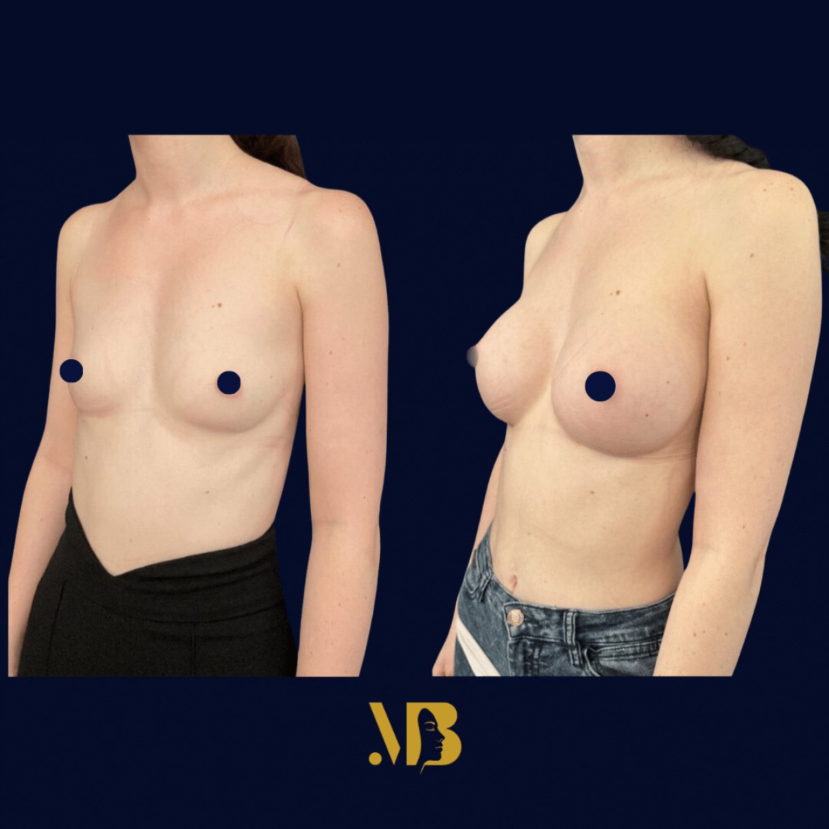 Результаты до и после увеличения груди в Michaël Benoilid Plastic and Cosmetic Surgeon Paris