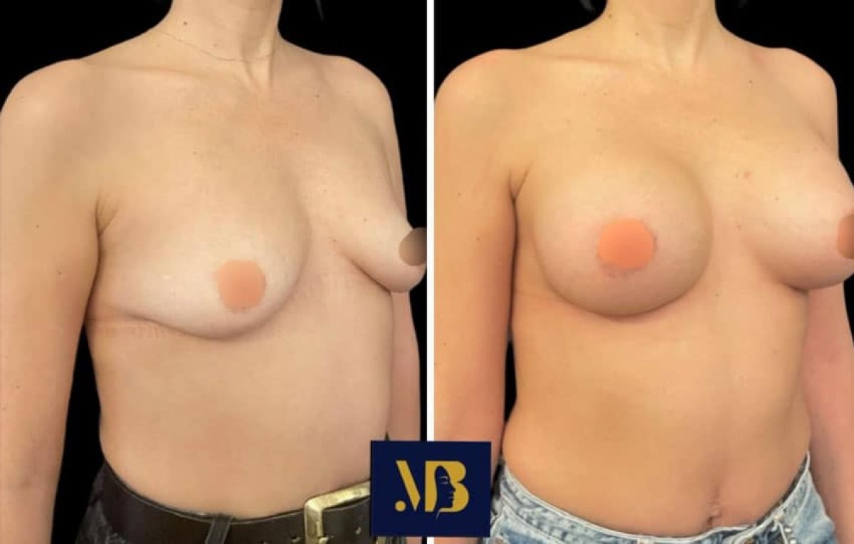 Résultats avant et après augmentation mammaire chez Michaël Benoilid Plastic and Cosmetic Surgeon Paris
