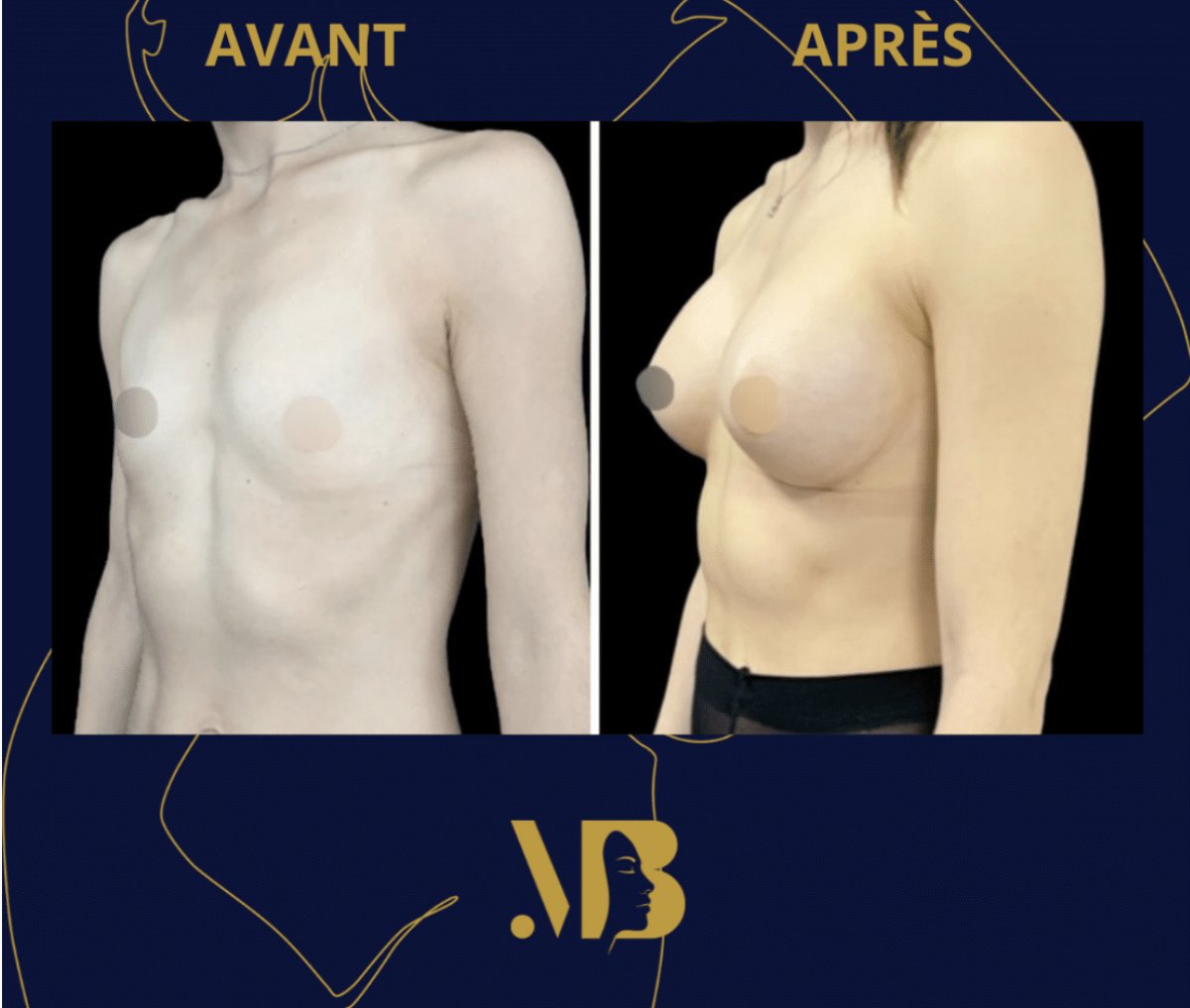 Результаты до и после увеличения груди в Michaël Benoilid Plastic and Cosmetic Surgeon Paris
