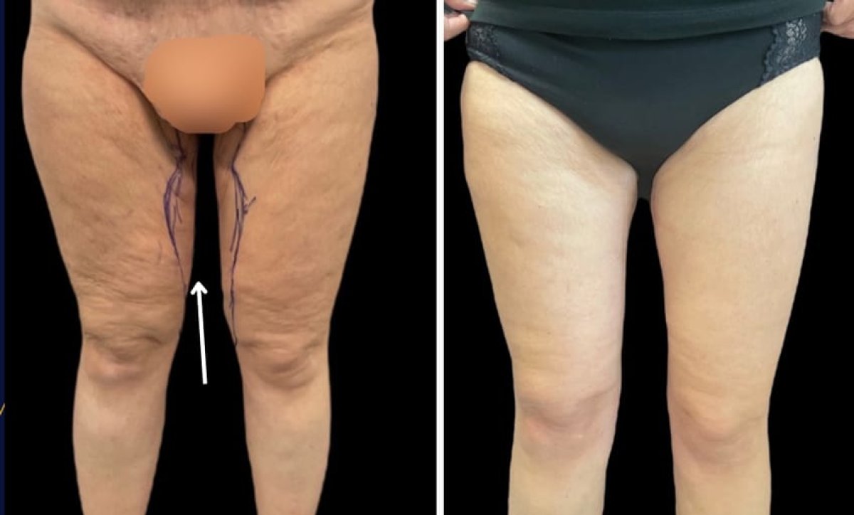 Before and after thigh liposuction results at Michaël Benoilid Plastic and Cosmetic Surgeon Paris