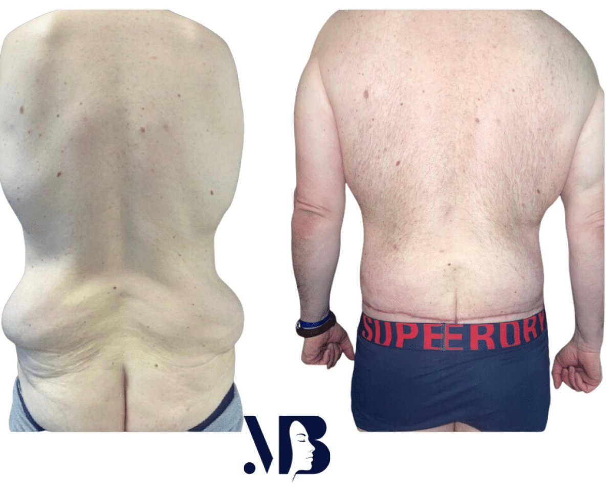 Before and after full body lift results at Michaël Benoilid Plastic and Cosmetic Surgeon Paris France
