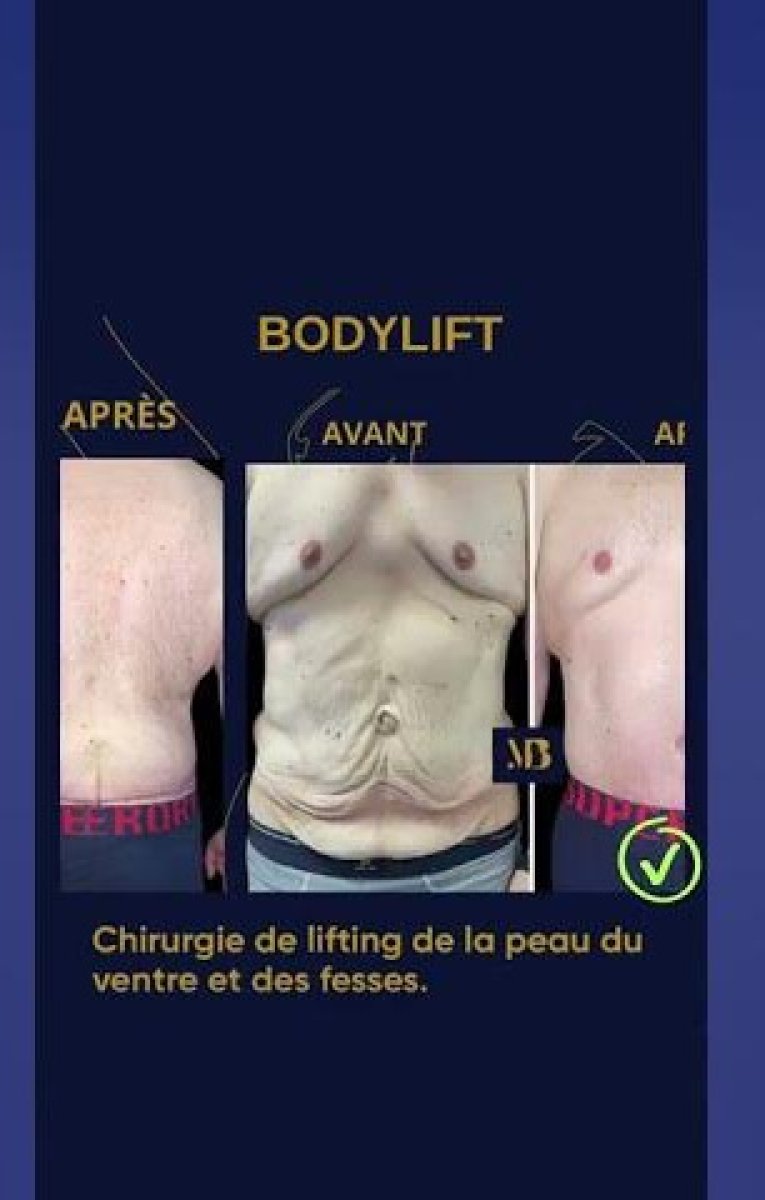 Before and after full body lift results at Michaël Benoilid Plastic and Cosmetic Surgeon Paris France