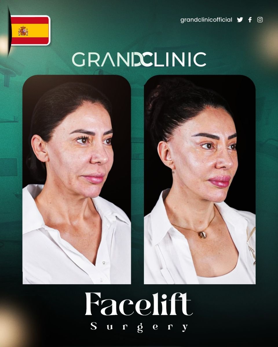 Resultados de lifting facial antes y después en Grand Clinic – rejuvenecimiento visible