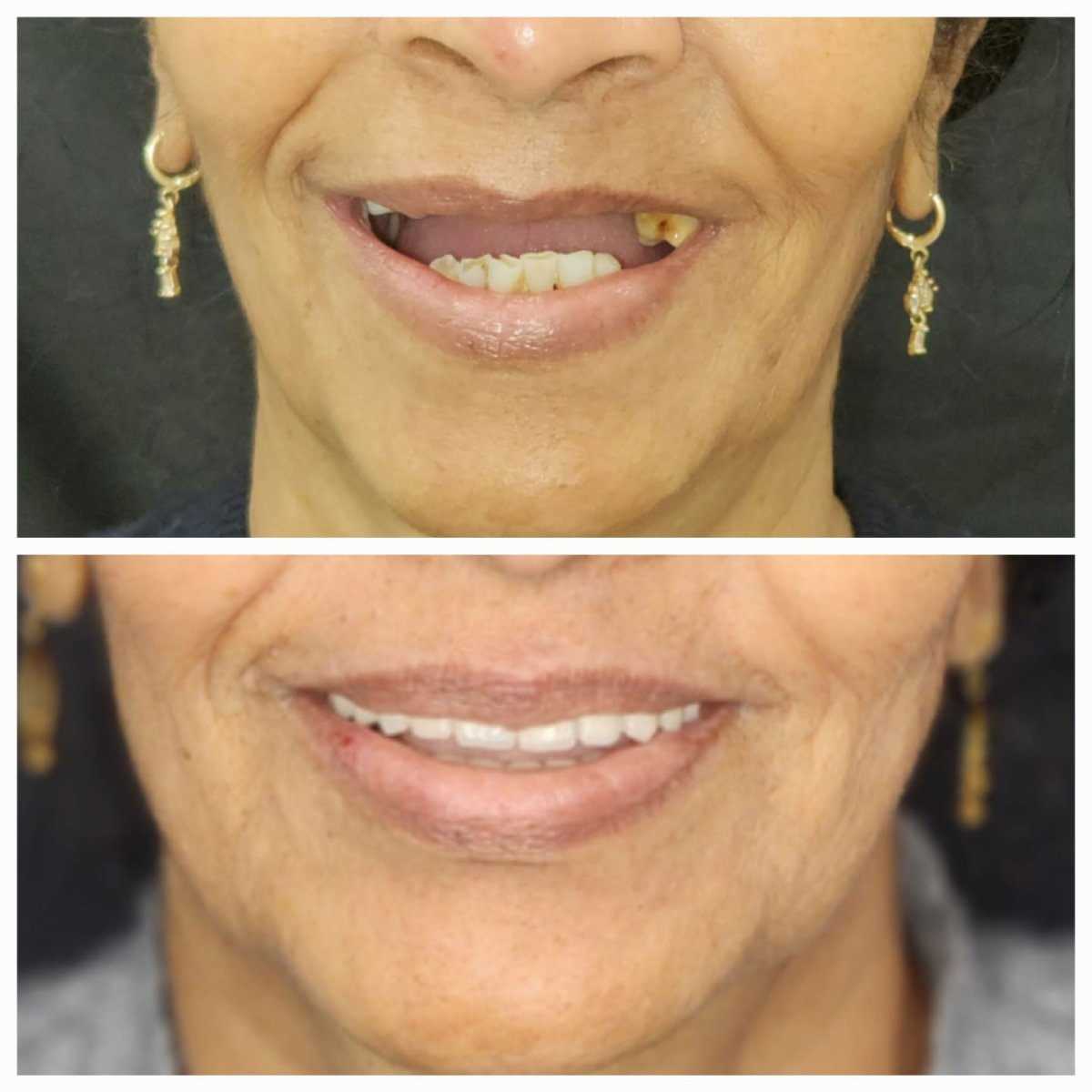 Résultat avant/après implants dentaires All-on-6 – sourire restauré et dents améliorées