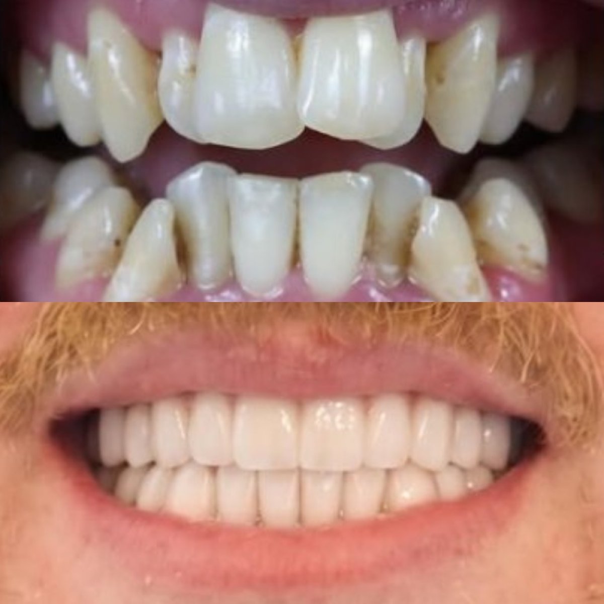 Résultats avant et après pose de couronnes zircone à Karat Dental Clinic, sourire amélioré