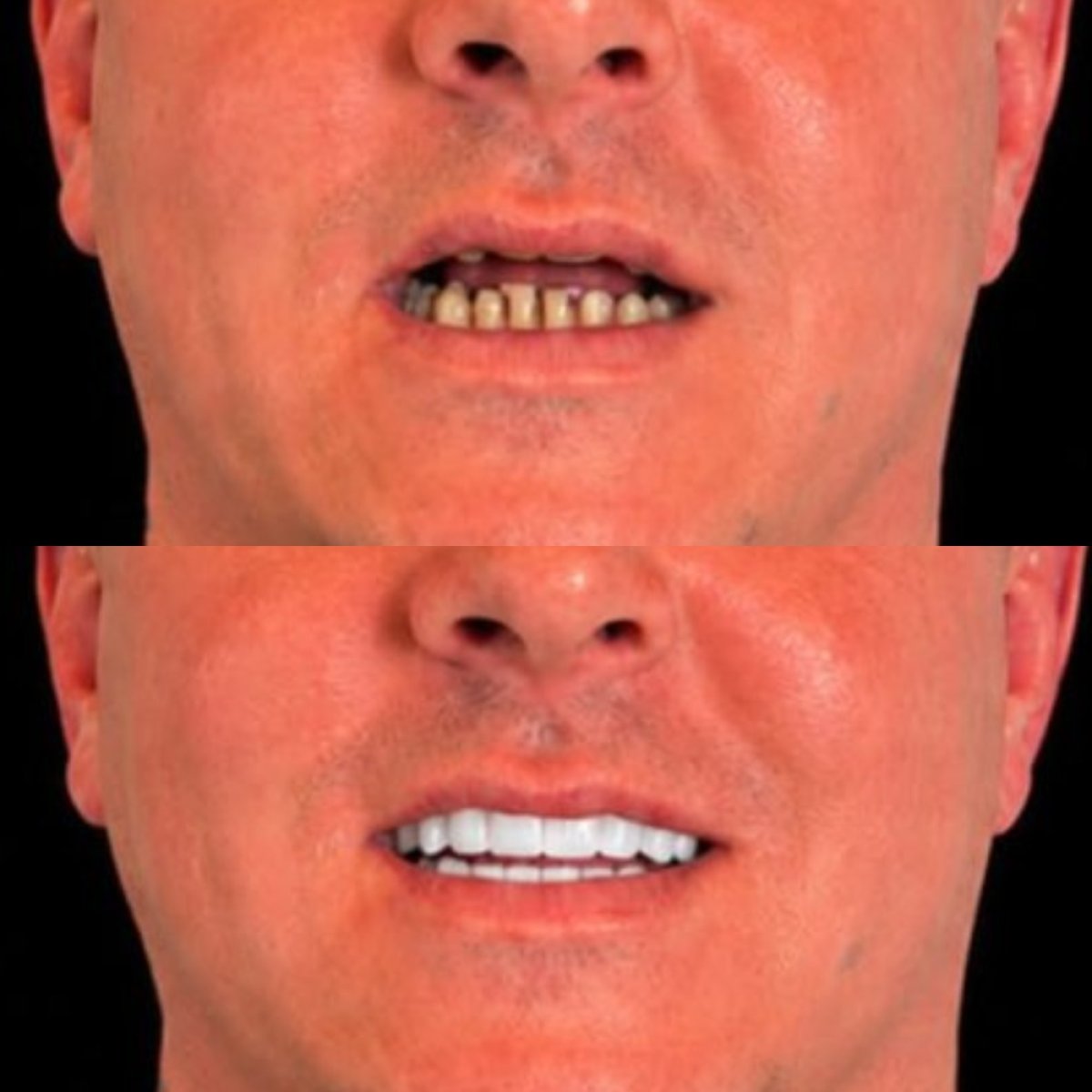 Avant et après pose de couronnes zircone à Karat Dental Clinic – résultat sourire restauré