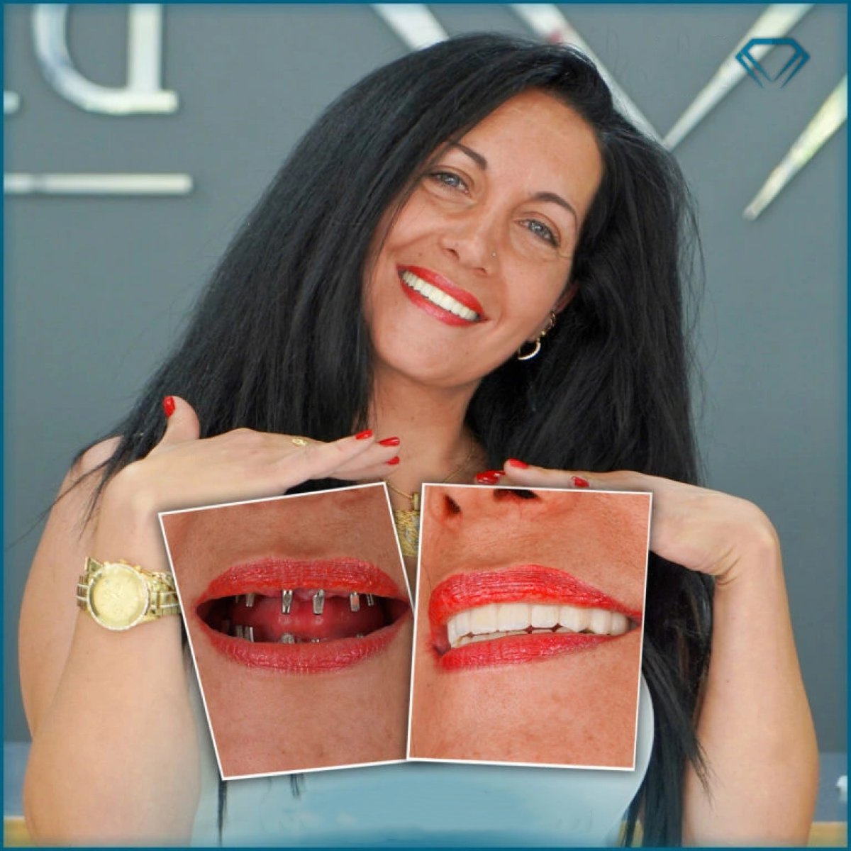 Before and after dental implant with crown results at Karat Dental Clinic, smile restoration