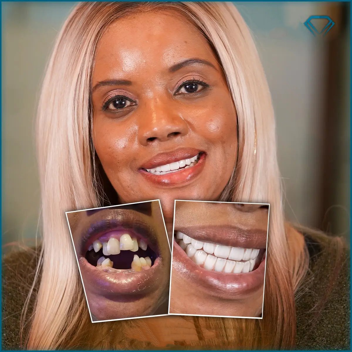 Before and after All-on-4 dental implants result at Karat Dental Clinic, smile restoration