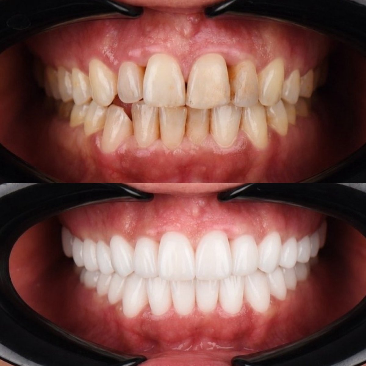 Resultados antes y después de carillas de porcelana en Astra Dental Clinic – transformación de sonrisa