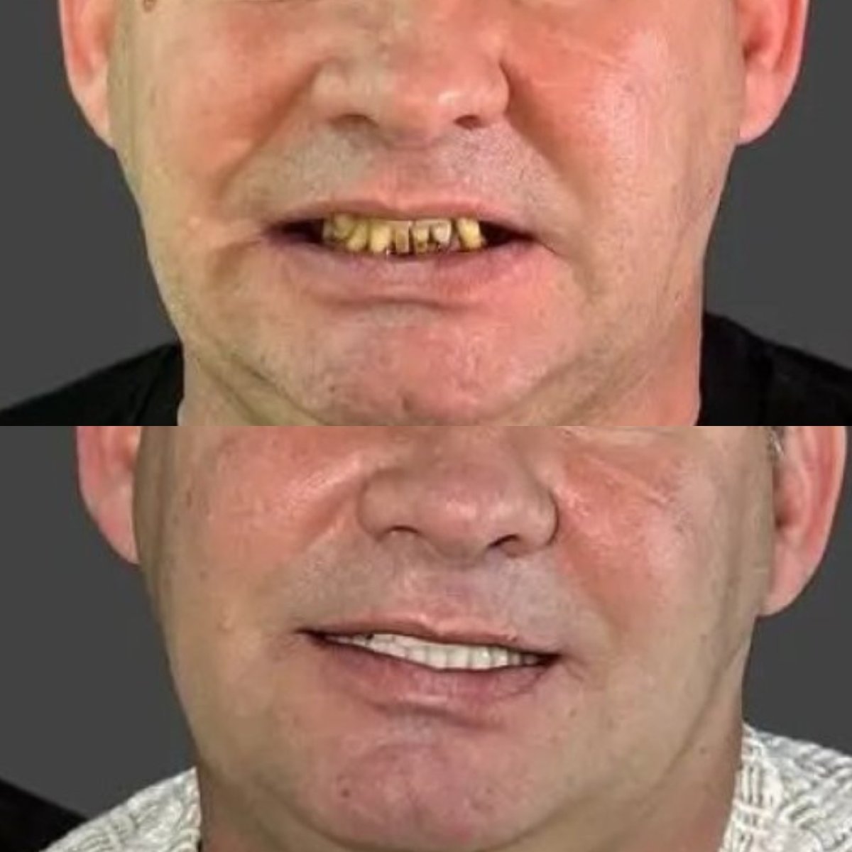 Результати до і після відбілювання зубів в Astra Dental Clinic, покращення усмішки