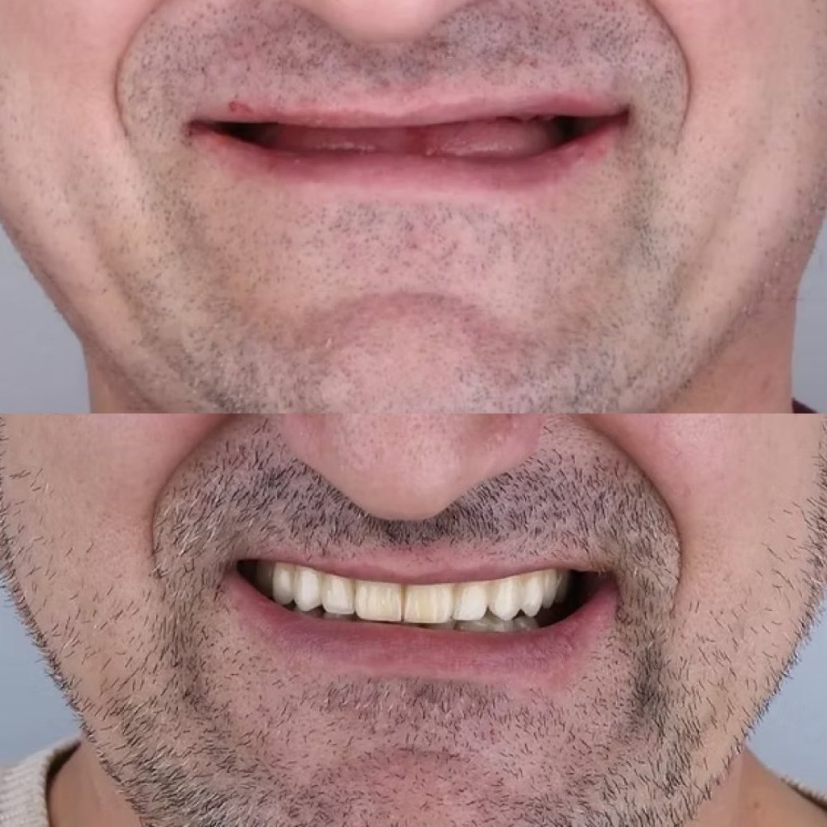 Resultados antes y después de implantes All-on-4 en Funda Sarıkaya Diş Polikliniği Ankara
