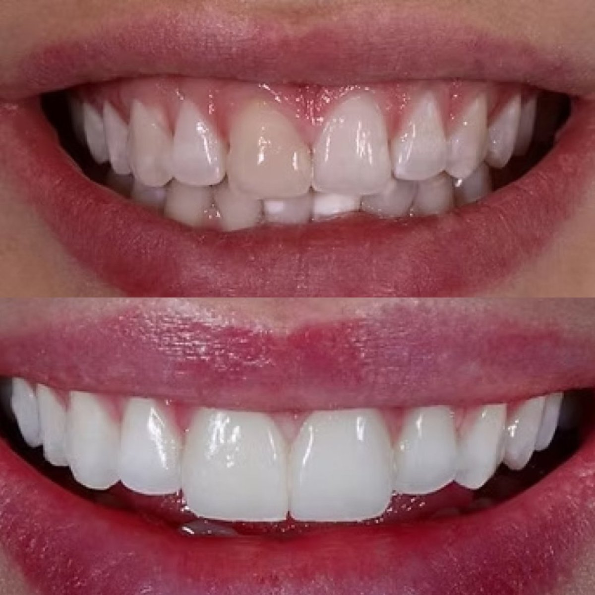 Résultat avant-après facettes dentaires à Funda Sarıkaya Diş Polikliniği - Dental Clinic, sourire transformé