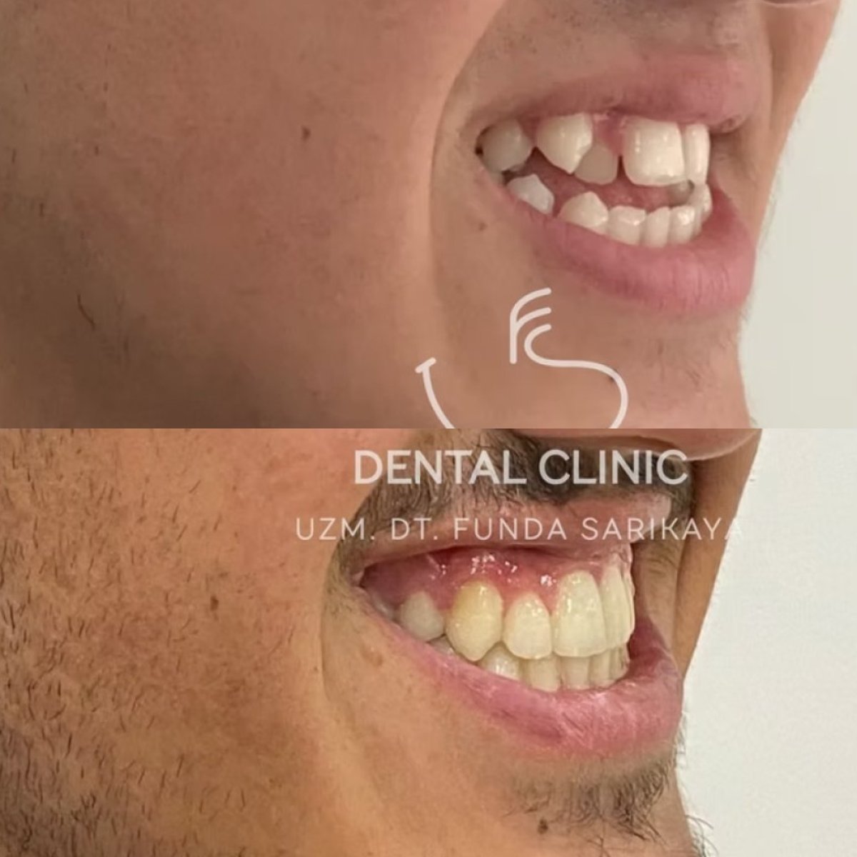 Resultado antes y después de alineadores en Funda Sarıkaya Dental Clinic, alineación dental mejorada
