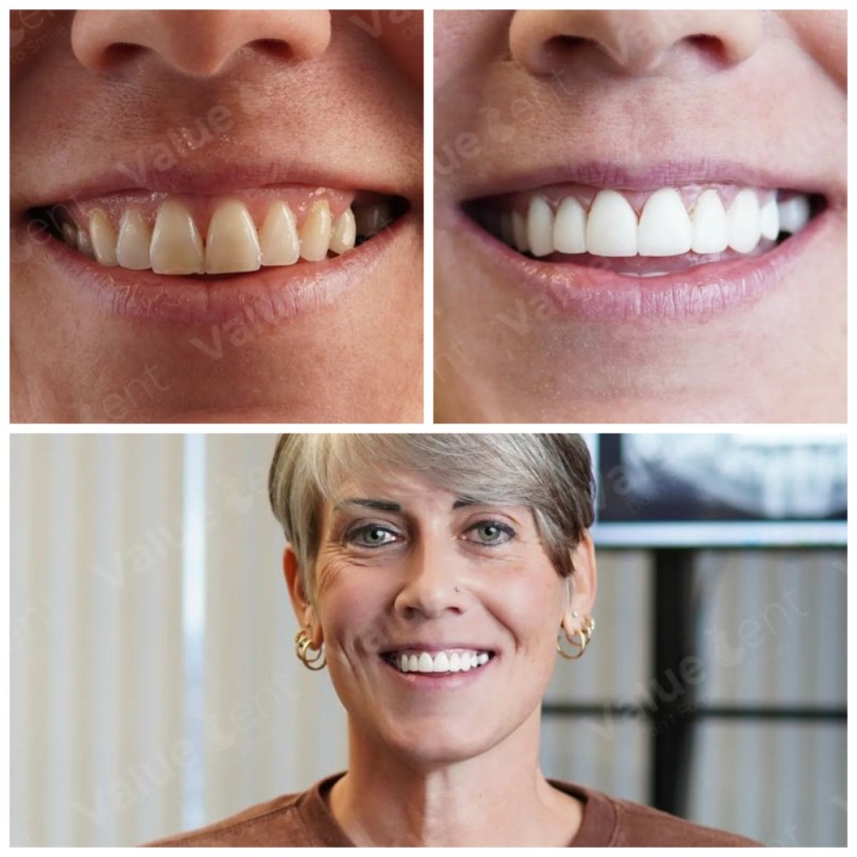 Resultados antes y después de carillas de porcelana en Valuedent Clinic – transformación de sonrisa