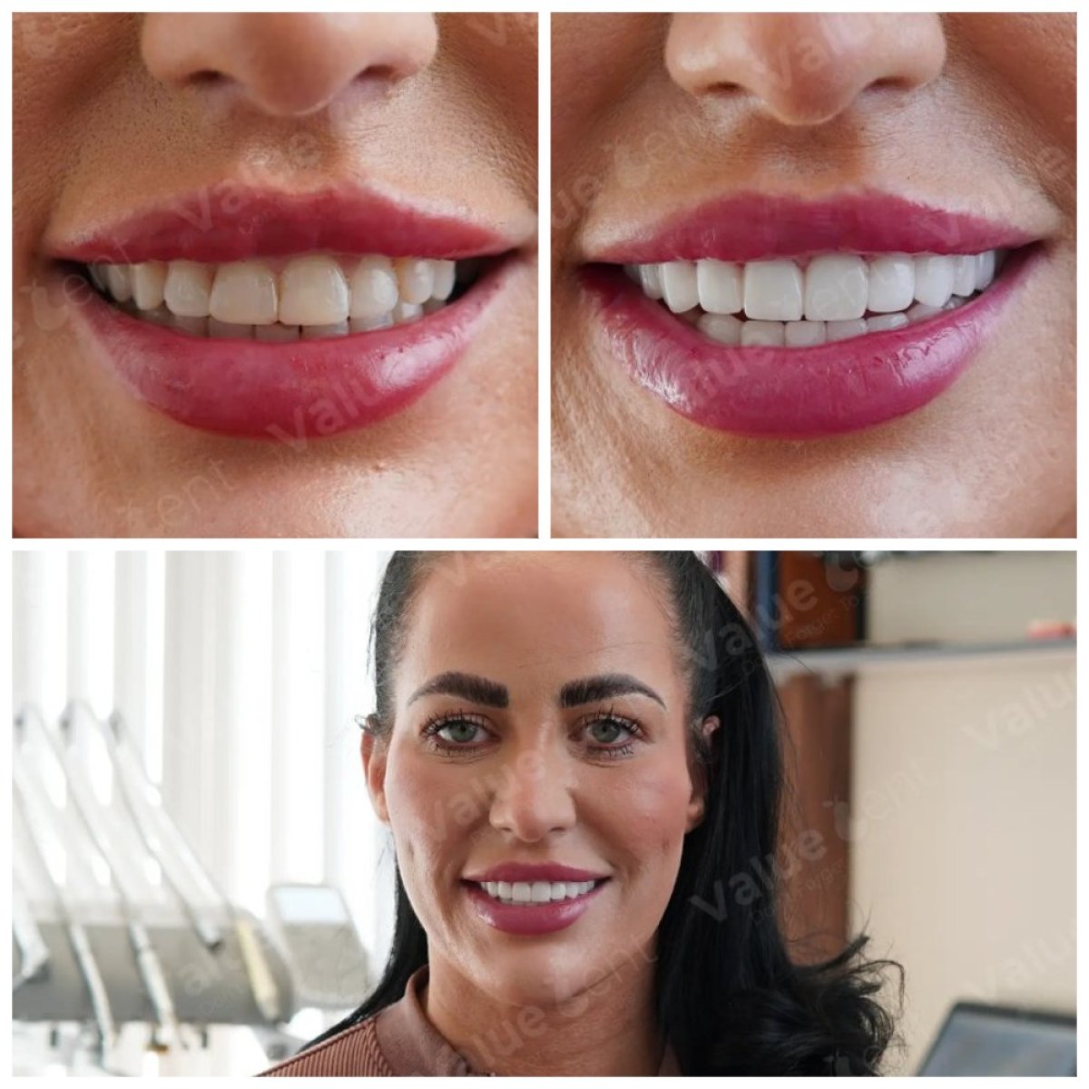 Before and after veneers at Valuedent Clinic – smile transformation with natural results