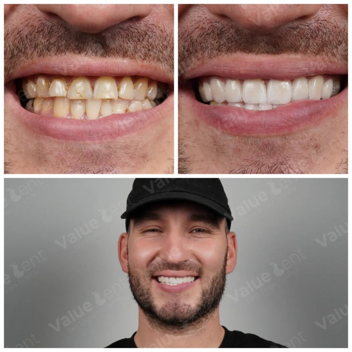 Before and after veneers at Valuedent Clinic – smile makeover with whiter, even teeth result