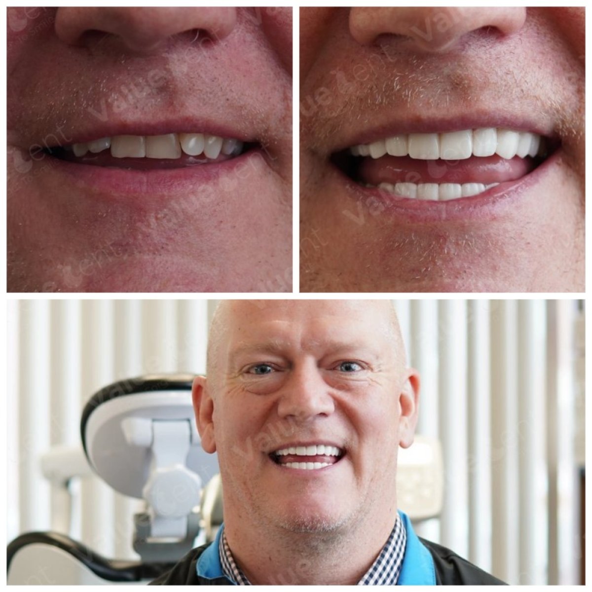 Before and after tooth whitening results at Valuedent Clinic, brighter smile transformation