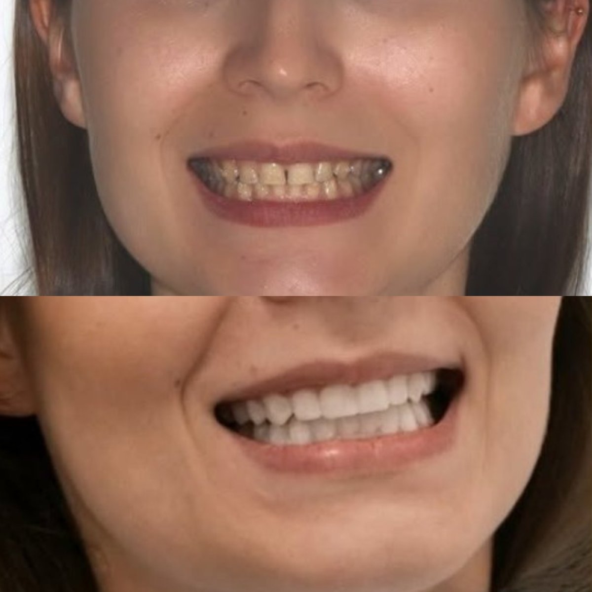 Before and after dental bonding results at Corten Dental Elite, improved smile aesthetics
