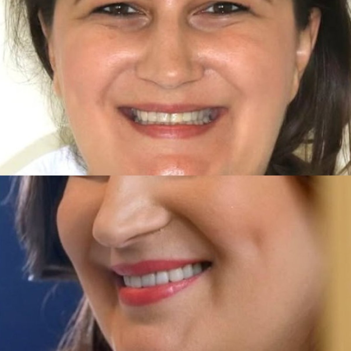 Resultados antes y después de Hollywood Smile en Corten Dental Elite, transformación visible