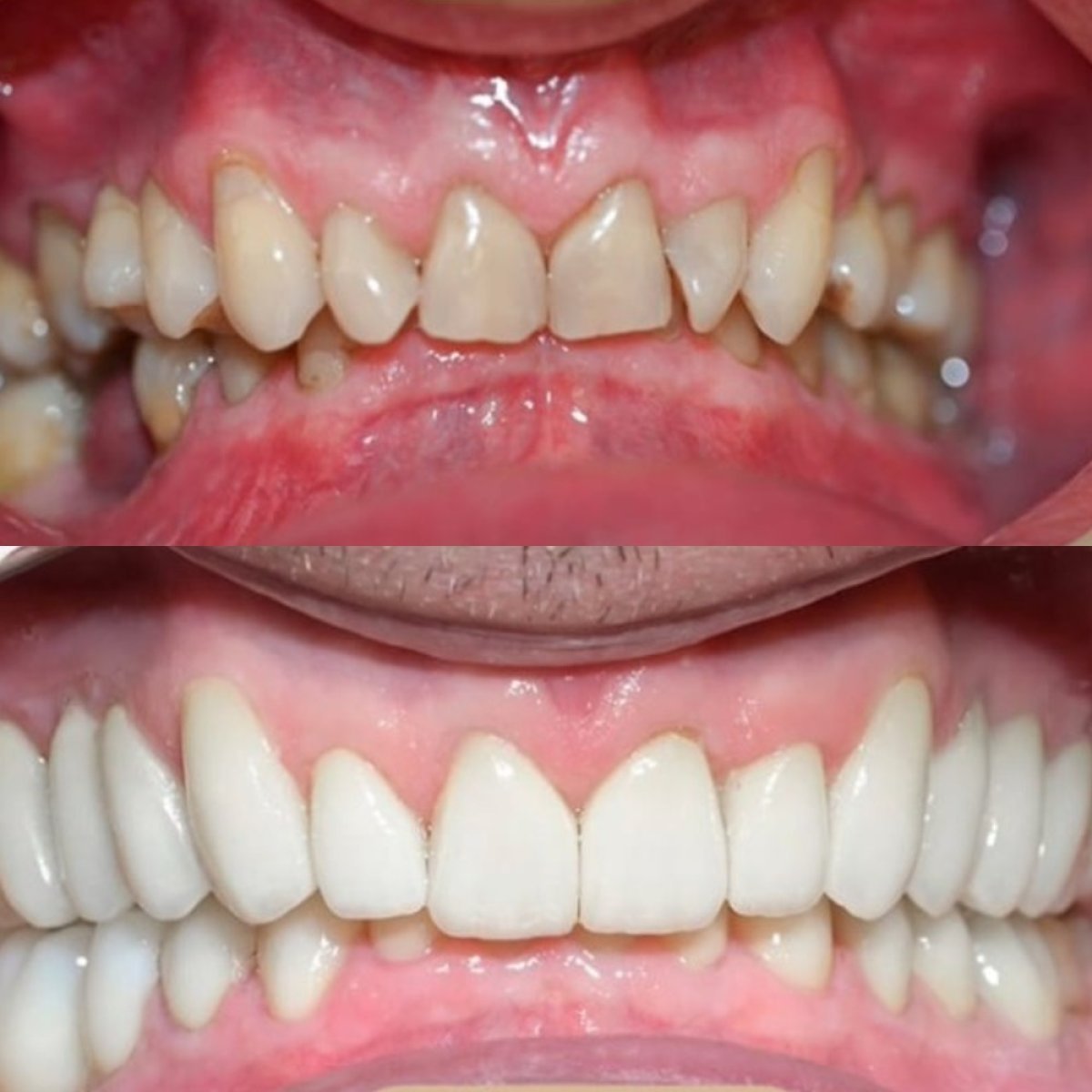 Smile makeover before and after results at Punta cana dentist odontologia familiar, improved teeth alignment