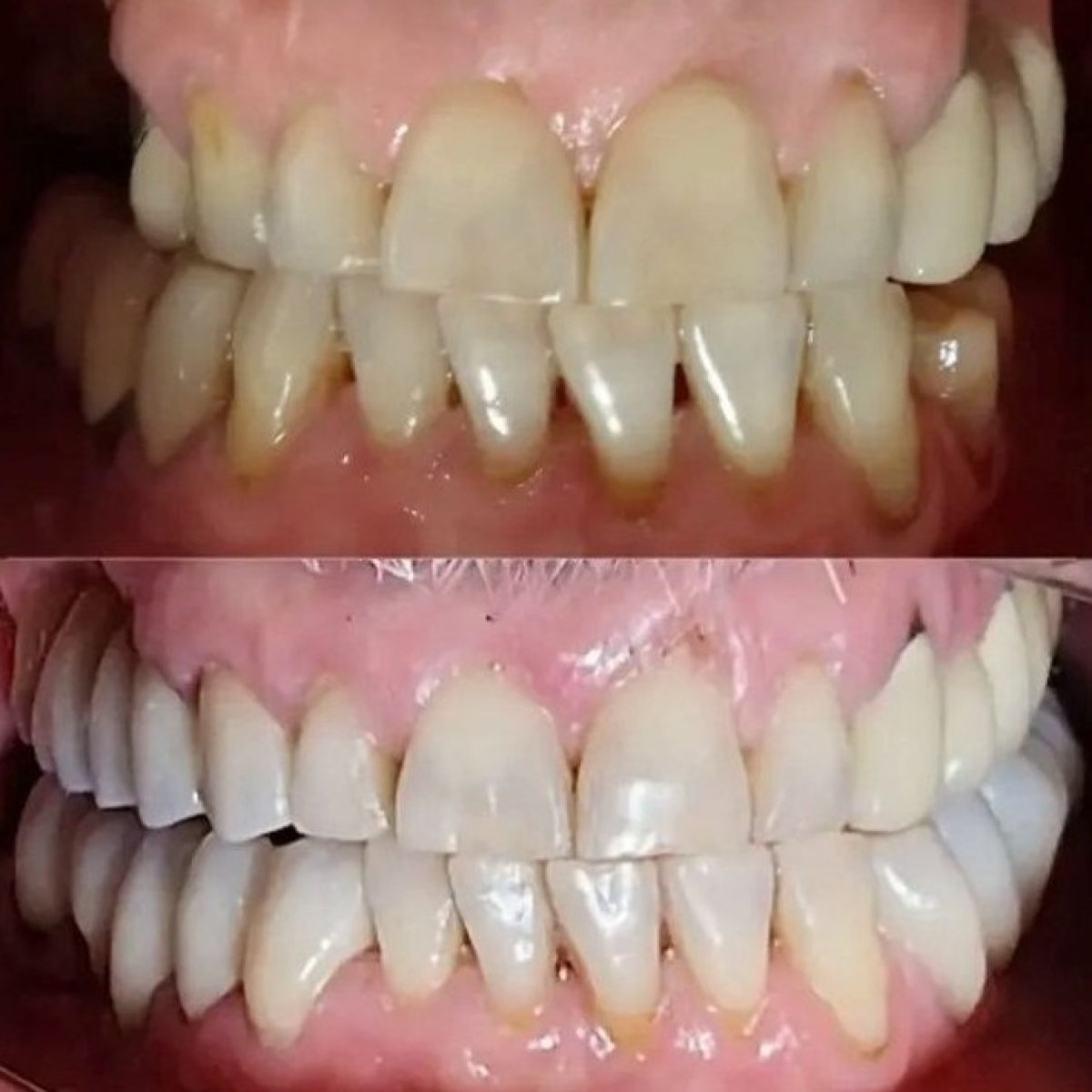 Before and after smile makeover results at Punta cana dentist odontologia familiar, whiter teeth