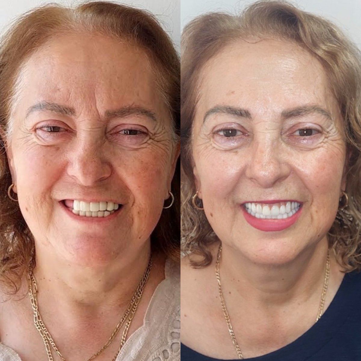 Before and after All-on-4 dental implants result – improved smile and teeth restoration