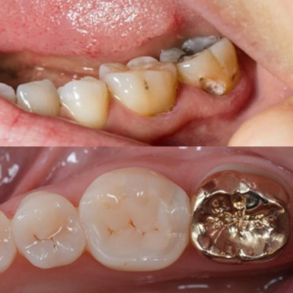Результат до и после установки золотой коронки в SAIGON CENTER DENTAL CLINIC, восстановленный моляр