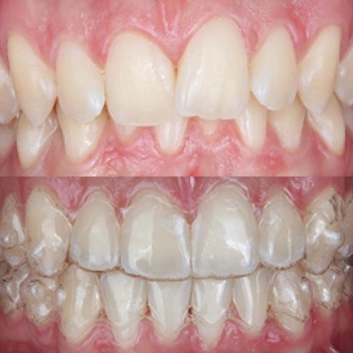 Результат до и после лечения элайнерами в SAIGON CENTER DENTAL CLINIC, выравнивание зубов
