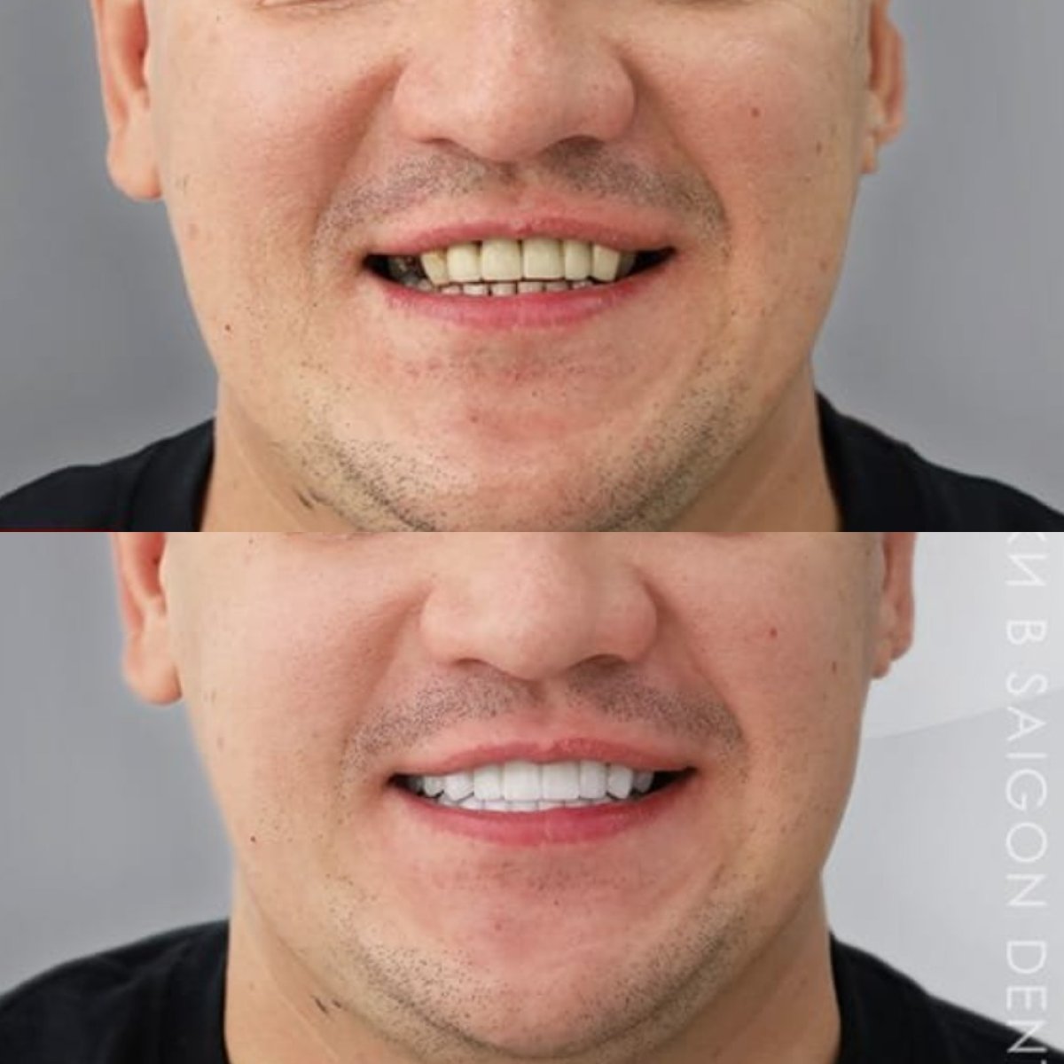 Before and after porcelain crown results at SAIGON CENTER DENTAL CLINIC, smile makeover