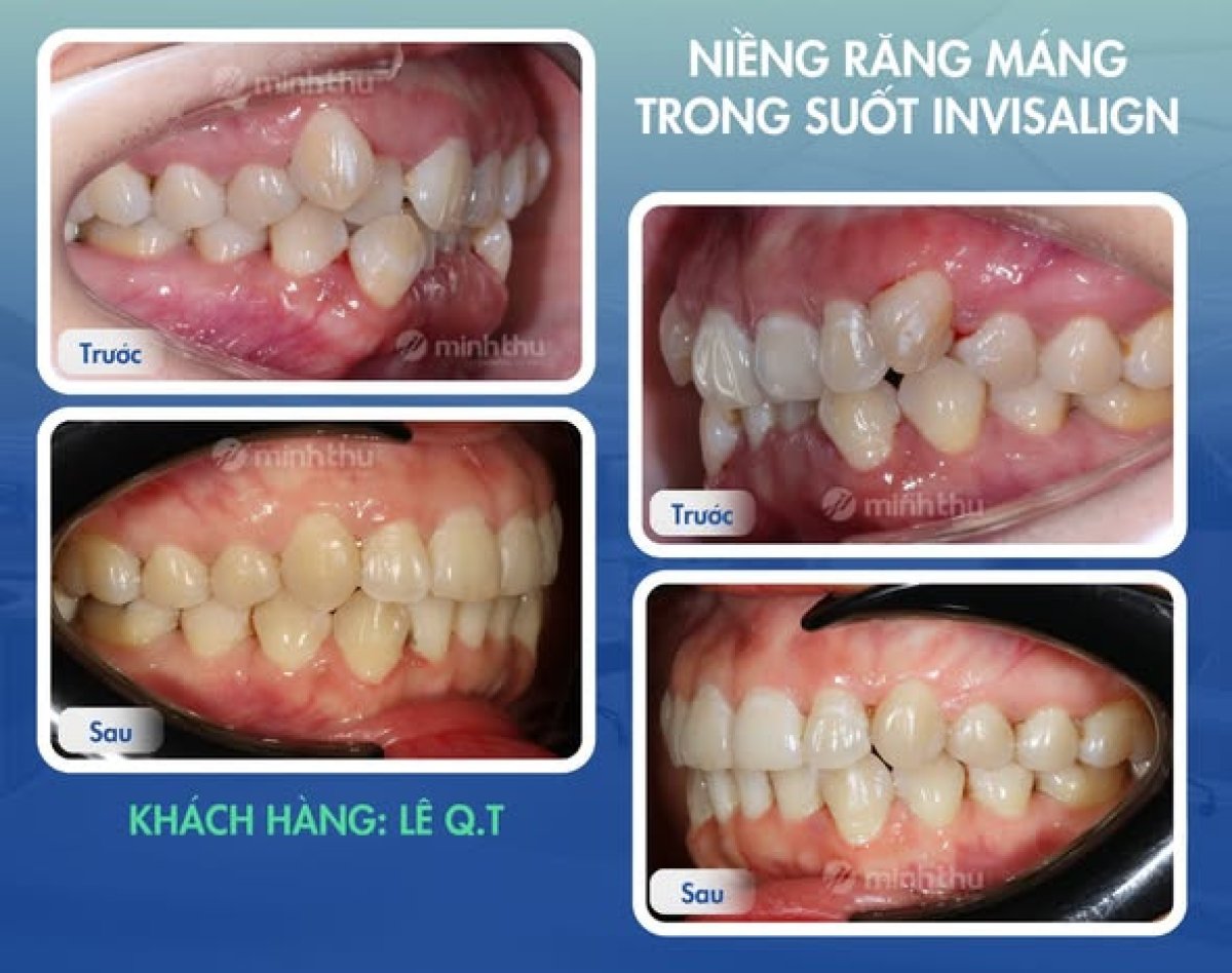 Результаты до и после элайнеров в Minh Thu Dental Clinic, выравнивание зубов