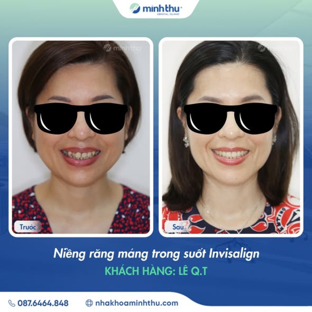 Efekty przed i po Invisalign w Minh Thu Dental Clinic, poprawiony uśmiech